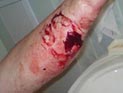 На Украине главврач больницы, торговавший наркотиками, покусал при задержании сотрудника прокуратуры На Украине главврач больницы, торговавший наркотиками, покусал при задержании сотрудника прокуратуры